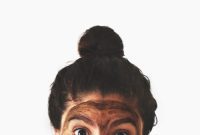 My Battle with Adult Acne: Part One